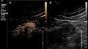 Sonovue microbubble ultrasound contrast evaluation of a renal mass